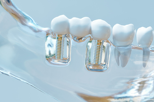 Photograph of multiple dental implants from Lakewood Dental Arts in Lakewood, CA Photograph of multiple dental implants from Lakewood Dental Arts in Lakewood, CA