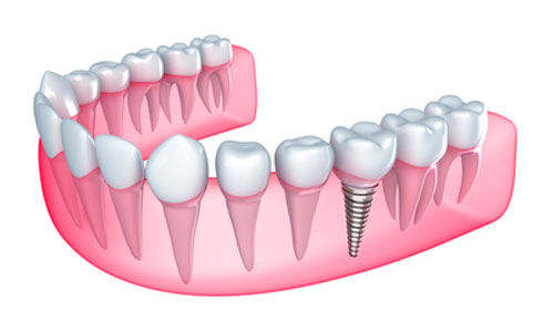 What Are Full-Arch Dental Implants?