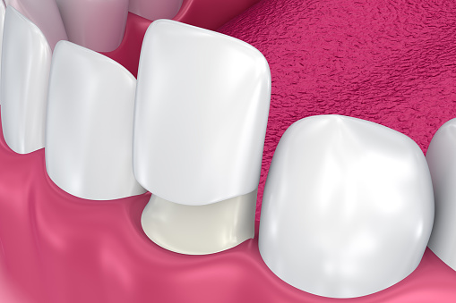 Close up diagram of porcelain veneer from Lakewood Dental Arts in Lakewood, CA
