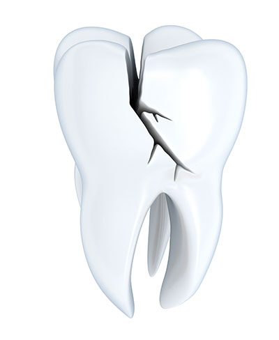 Causes And Treatment For Half Broken Molar Tooth