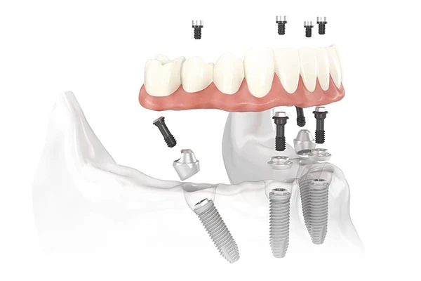 A 3d Rendering of All on 4 Treatment Concept A 3d Rendering of All on 4 Treatment Concept