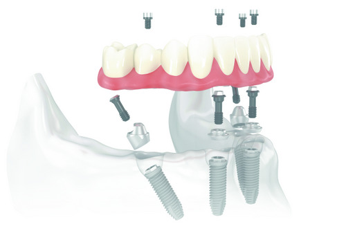 Diagram of All-on-4 Treatment Concept from Lakewood Dental Arts