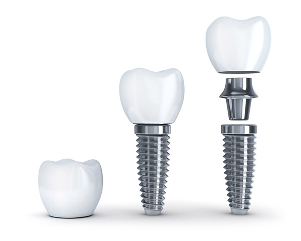 Diagram of dental implant with post from Lakewood Dental Arts in Lakewood, CA