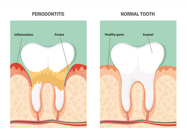 Diagram of periodontitis and healthy tooth at Lakewood Dental Arts in Lakewood, CA