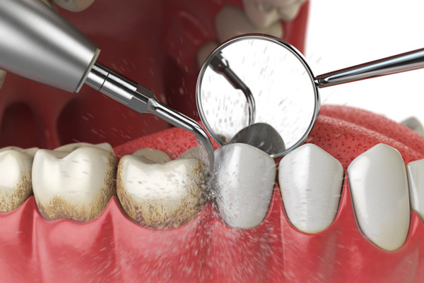 Diagram of teeth and gum cleaning at Lakewood Dental Arts in Lakewood, CA