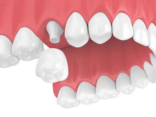 Rendering of jaw with dental crown from Lakewood Dental Arts in Lakewood, CA Rendering of jaw with dental crown from Lakewood Dental Arts in Lakewood, CA